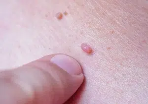 عوامل موثر در ابتلا به ویروس HPV
