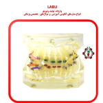 مولاژ دندان مدل ارتودنسی و درمان مالوکلوژن با براکت و کش های لیگاتور