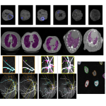بخش‌بندی تصویر پزشکی Image segmentation